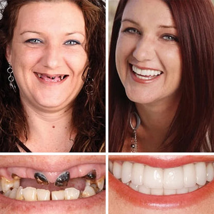 Medical Full Denture with Strong Suctiond🦷